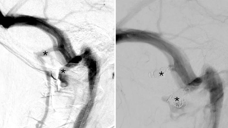 side-by-side scans of a vein in the brain