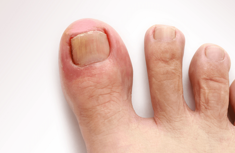 Care of Toe After Nail Removal: Essential Tips for Fast Healing