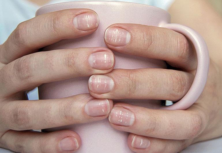 Half Moon Nails (Lunulae): What They Mean