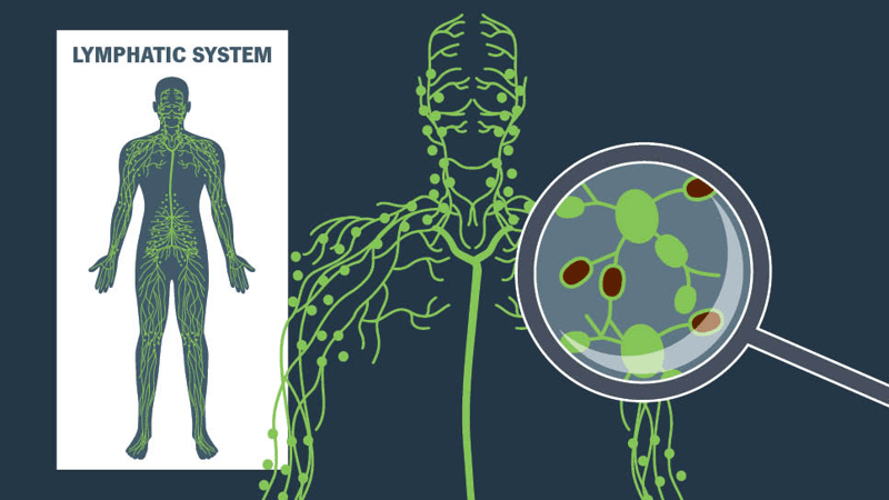 Do Swollen Glands Signal Lymph Node Cancer?
