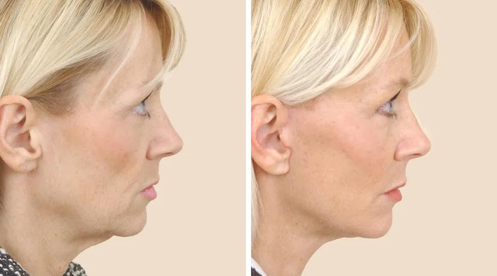 Facelift before & after photo