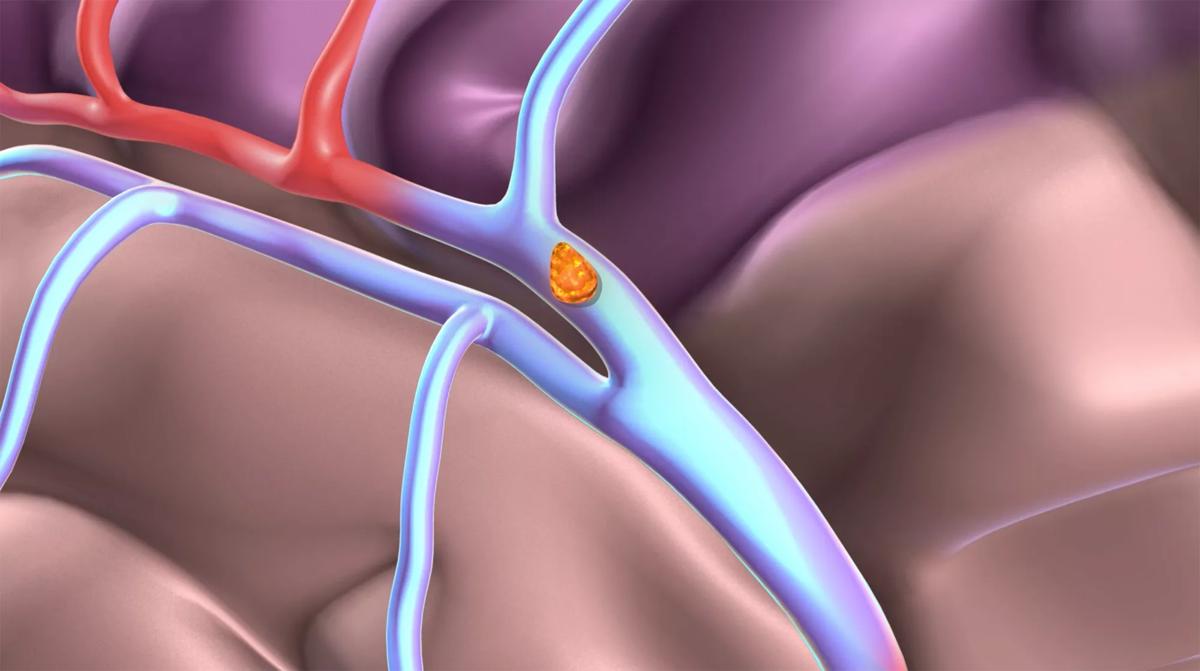 stroke-Cleveland-Clinic