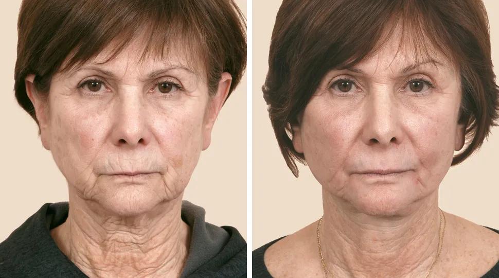 Facelift before & after photo