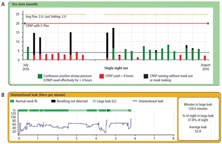 Download of positive airway pressure use data for a month (A) and leak data for a night (B).