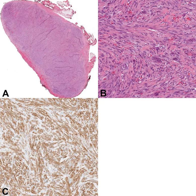 A. Hematoxylin and eosin stained section of well-circumscribed nodule in its capsule B. Higher magnification hematoxylin and eosin stained section showing spindle cells arranged in short fascicles and scattered red blood cells C. Spindle cells stained highly positive with smooth muscle actin