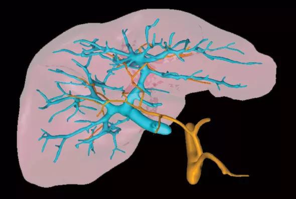 Liver-Transplant-fig2