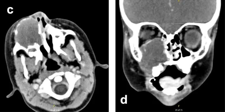 Computed Tomography (CT) scan of facial bone demonstrating mass involvement of right orbital rim.