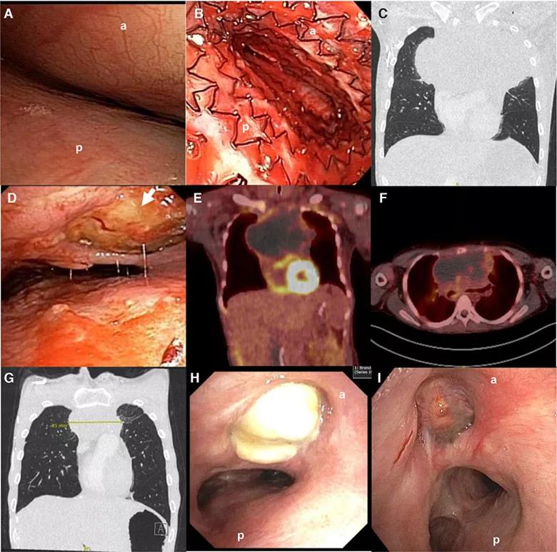 ECMO Provides Lifesaving Support to a Patient With Mediastinal Mass and Respiratory Failure 
