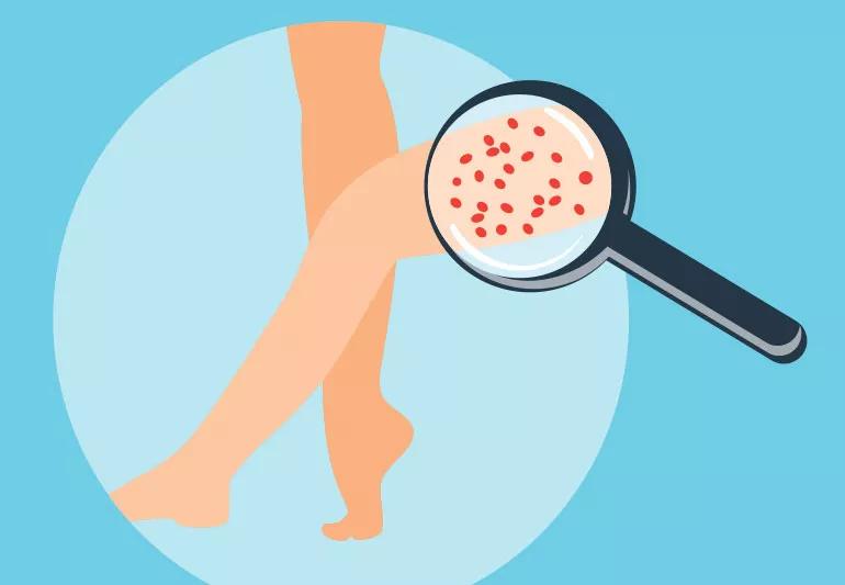 Strawberry Legs: Causes & Treatment