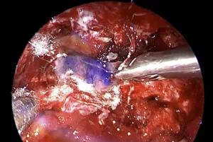 Planum reconstruction with free mucosal graft Dura intact