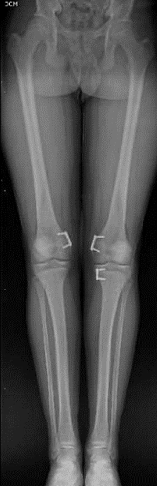 X-ray of patient with neutral mechanical axis