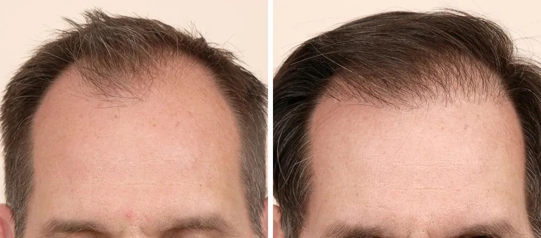 Before and after image of hair replacement surgery from the front
