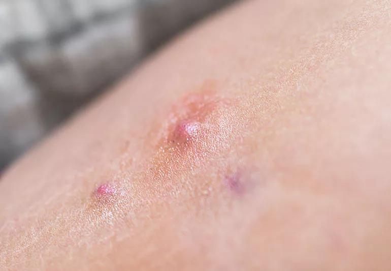Bumps on inner thigh - Glow Community