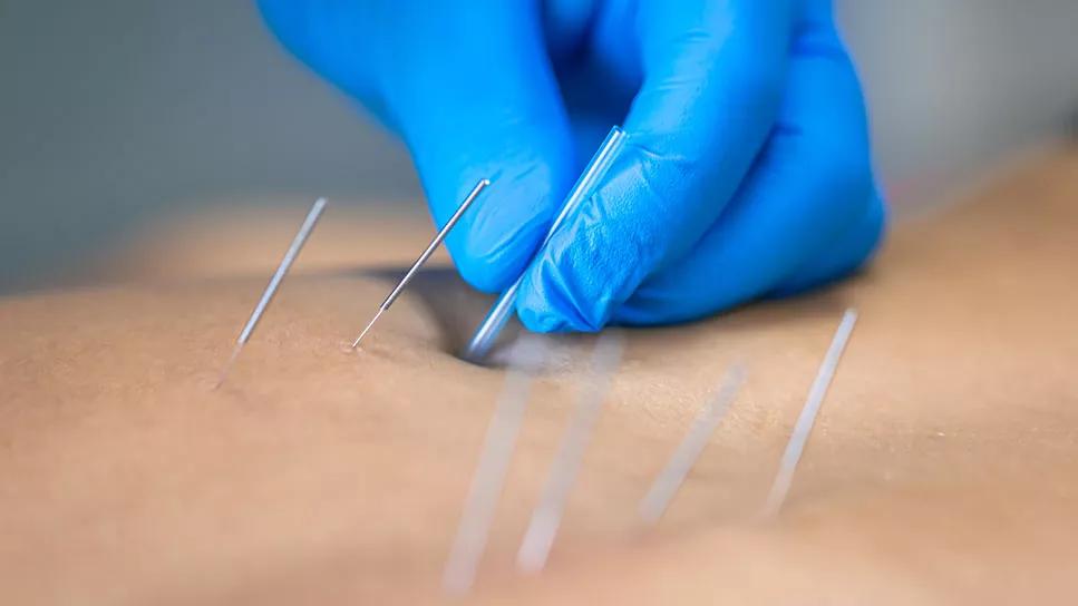 Dry needling to treat muscle pain - Mayo Clinic Health System