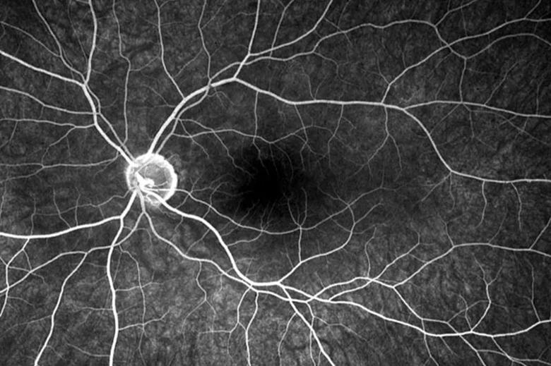 Angiography of healthy eye