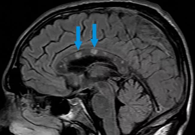 Susac syndrome