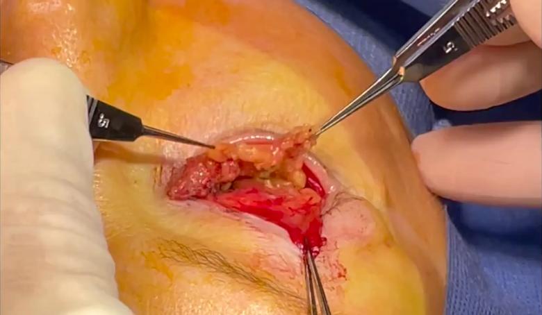 T-shaped pedicle of orbital fat
