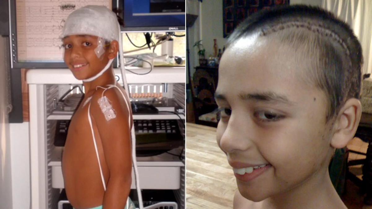 Cleveland-Clinic-Epilepsy-Seizures