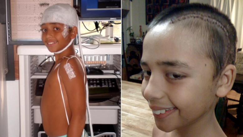 Cleveland-Clinic-Epilepsy-Seizures