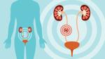 Passing Kidney Stones: What To Expect