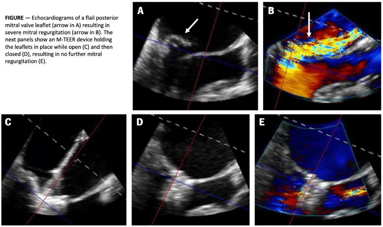 five echocardiogram images of the heart with a figure caption