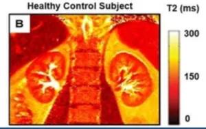 Kidney disease