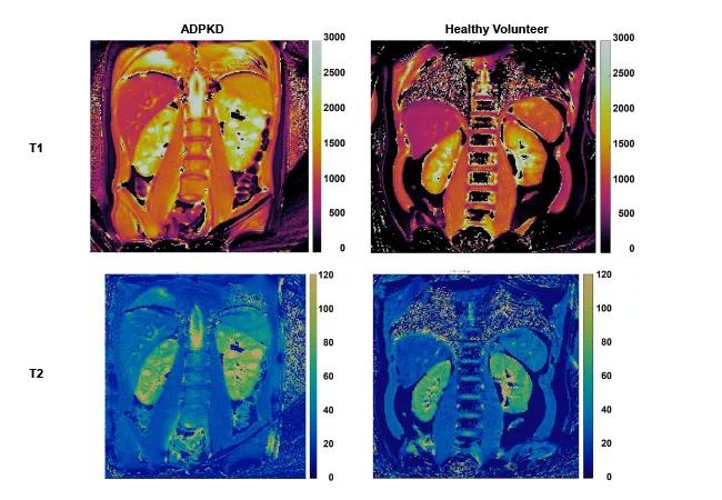 Side-by-side imaging of disease kidney with healthy kidney 