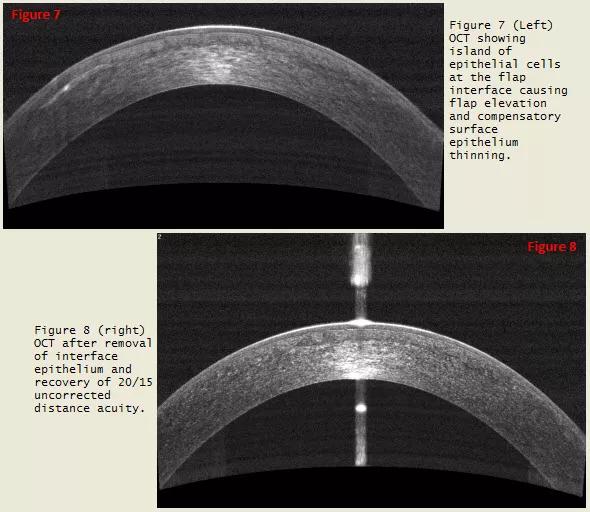 Enhancement 13 Years After Lasik