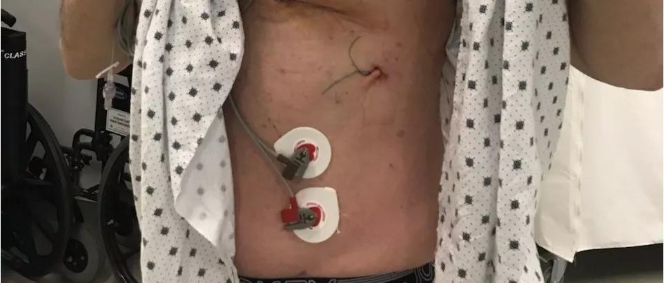 Photo of the patient’s postoperative scar.