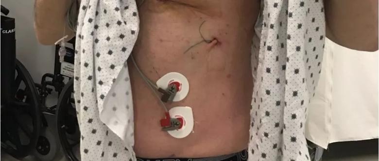 Photo of the patient’s postoperative scar.