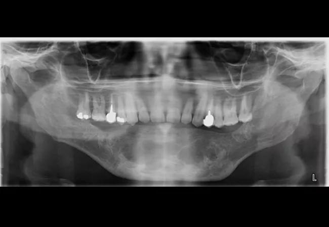 41-year-old male from Kuwait who presented with a large multilocular, expansile lesion in the mandible