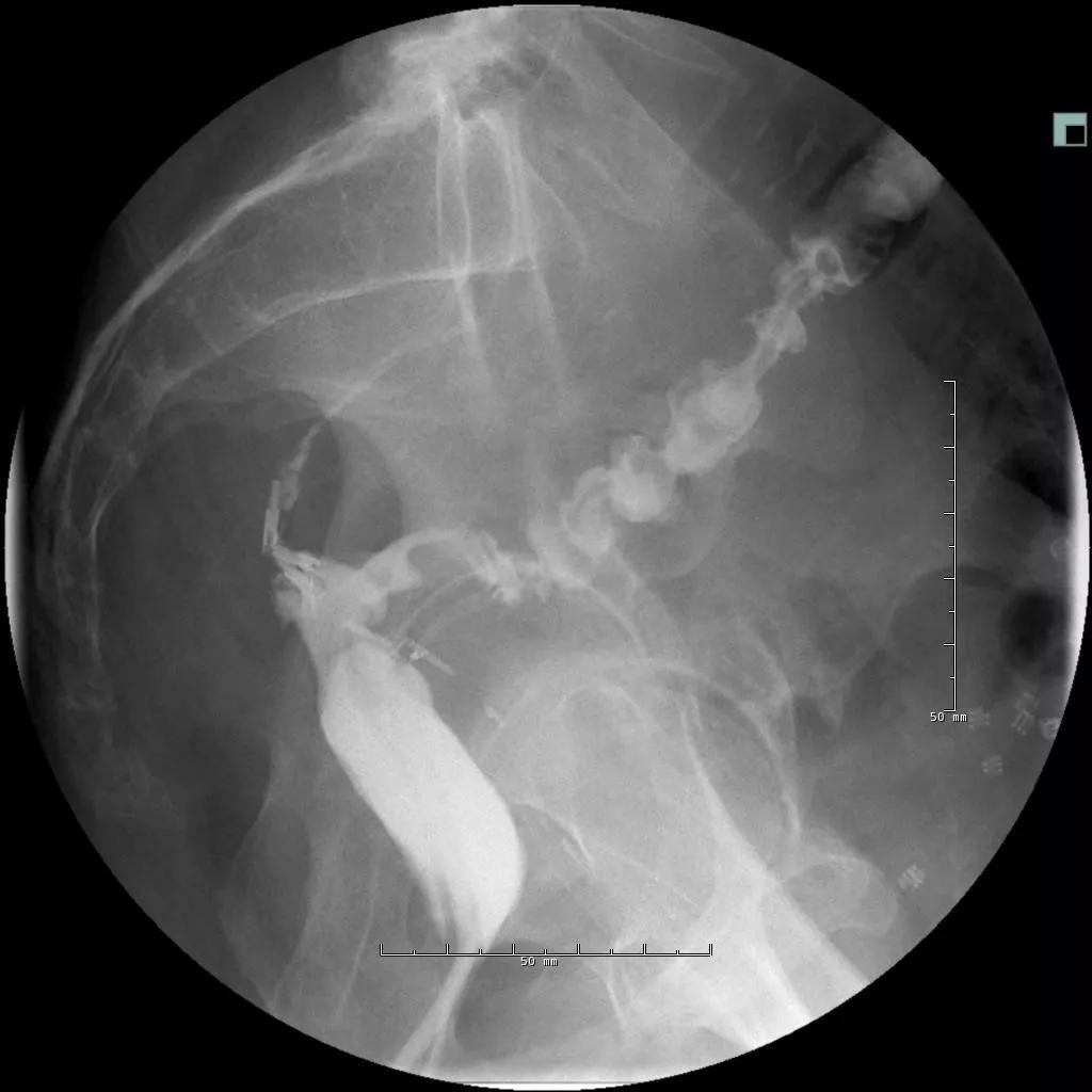 The long sinus track from the anastomosis.