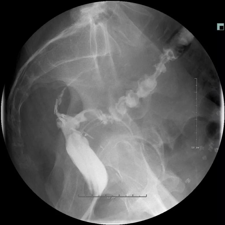 The long sinus track from the anastomosis.
