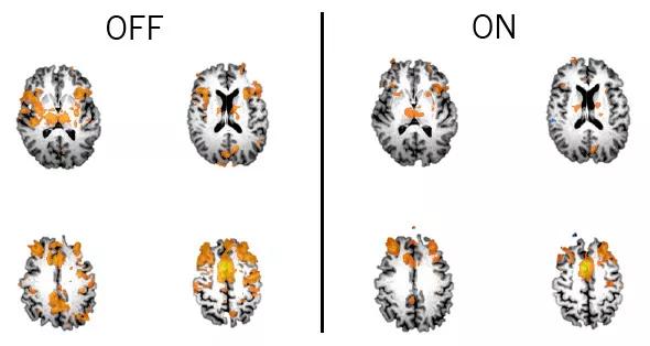 590x-Inset-Machado-Thalamic