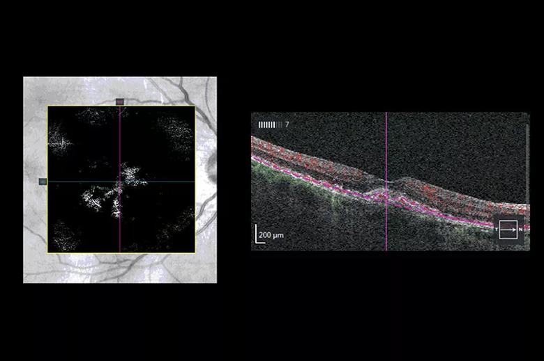 OCT-A confirming choroidal neovascular membrane