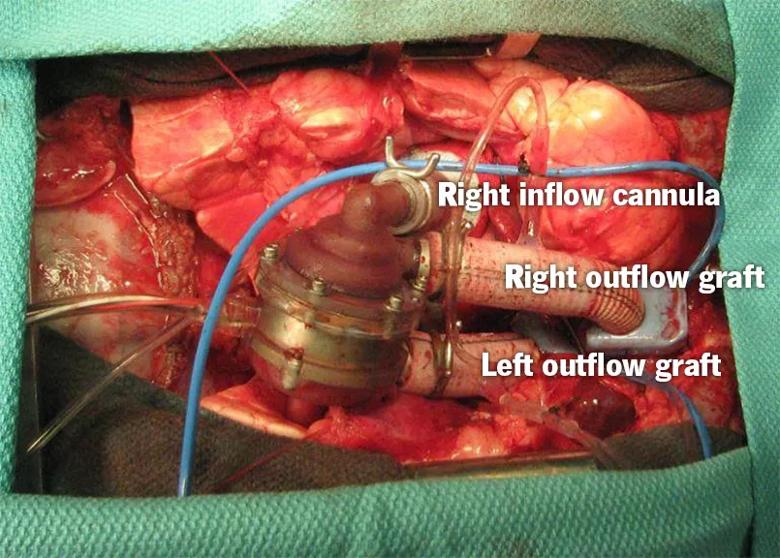Artificial heart