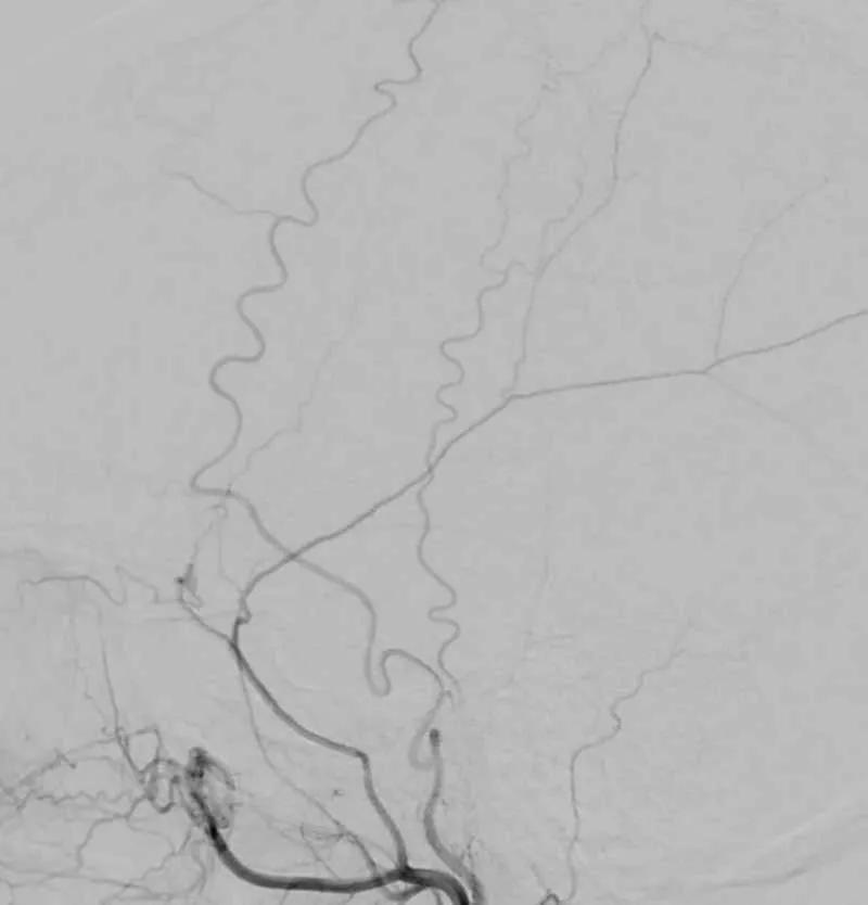 scan of wispy blood vessels against a light gray background