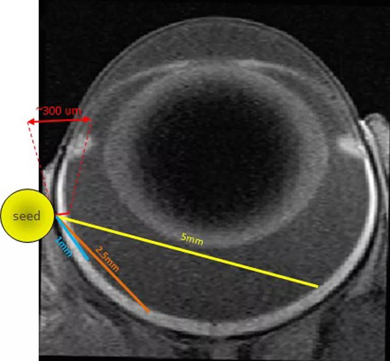Image shows positioning of a radioactive iodine seed in the left eye of Lewis rat.