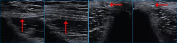 Figure 1. Longitudinal views on ultrasound neurography showing an abnormally thickened lateral femoral cutaneous nerve (arrow, left image) in contrast with the contralateral normal nerve (arrow, right image). Figure 2. Transverse views on ultrasound neurography demonstrating the same side-to-side difference as in Figure 1. 