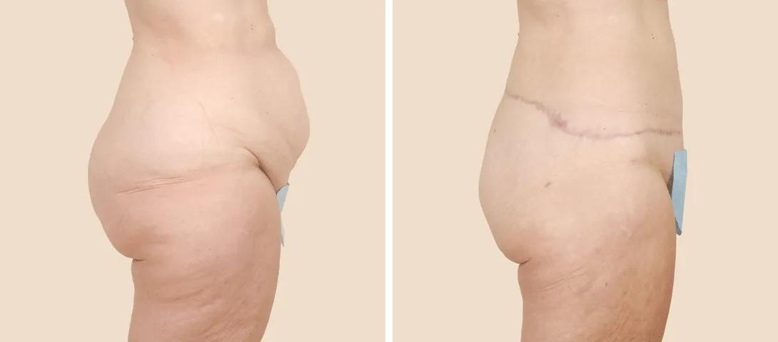 Before abdominoplasty (left) and not even 2 months after surgery (right).