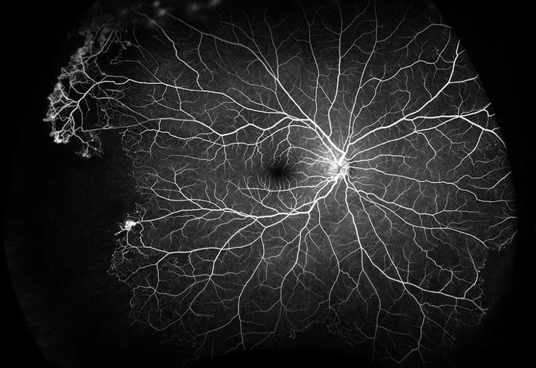 Blood vessels of the inside of the eye