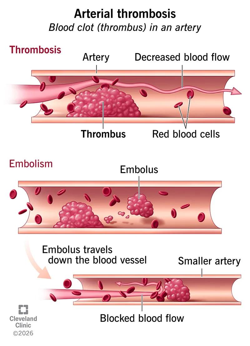 Arterial thrombosis (blood clot) blocking blood flow through an artery