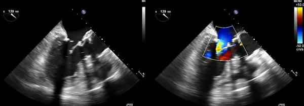Postoperative echoes showing the position and function of the homograft