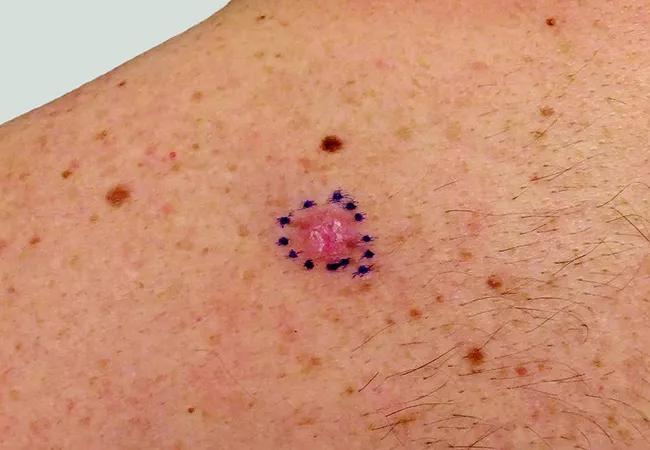 Rashes/Hives, Skin Cancer South Florida