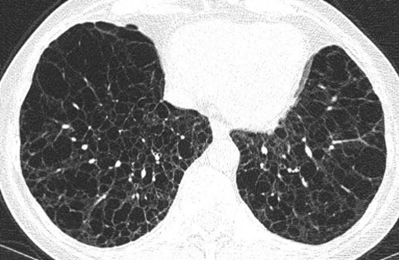 Biopsy scan of advanced stage of cystic lung disease 