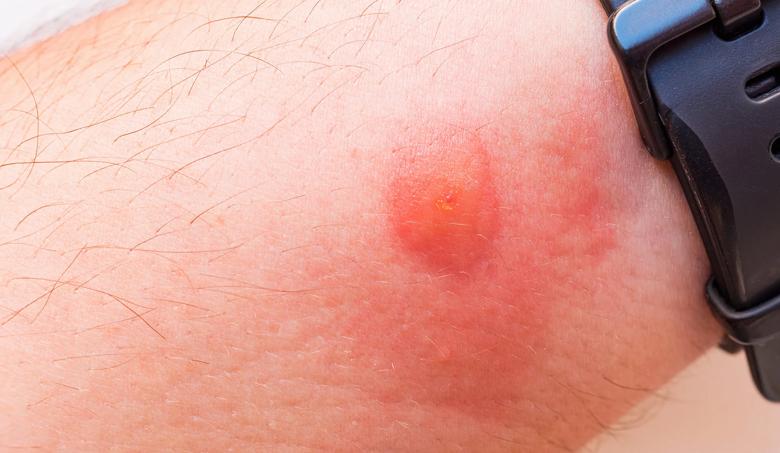 closeup of a horsefly bite on an arm