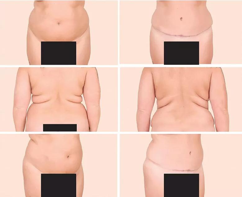 Lipo