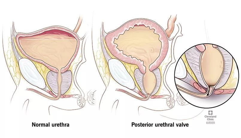 Posterior Urethral Valves