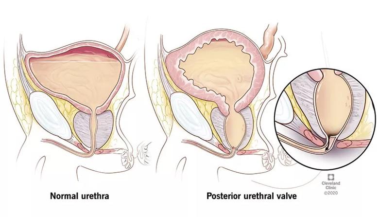Posterior Urethral Valves