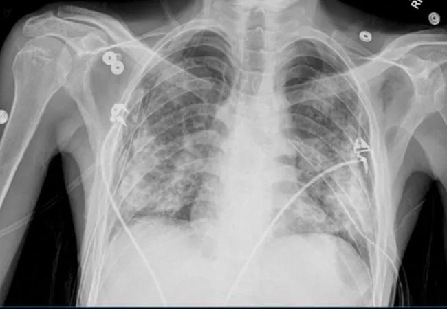 XRay of patient's chest